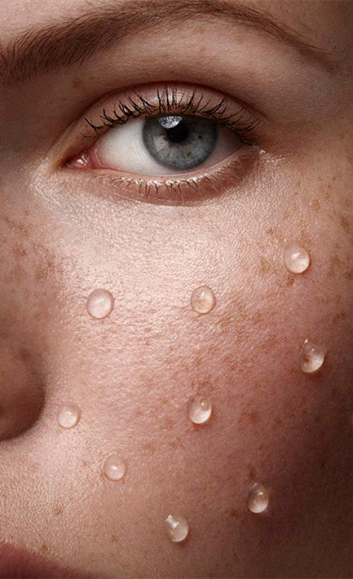 Как убрать морщины-марионетки филлерами 03 Как убрать морщины-марионетки филлерами 03