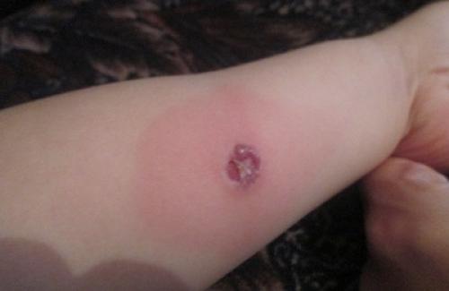 Чем опасен синяк после укола. Последствия появления гематомы