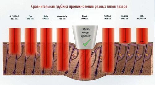 Какие риски и побочные эффекты могут возникнуть после александритового лазера Какие риски и побочные эффекты могут возникнуть после александритового лазера